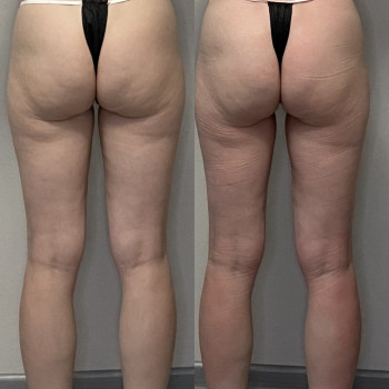 LPG массаж
                    Мануальный терапевт Виктория Киев