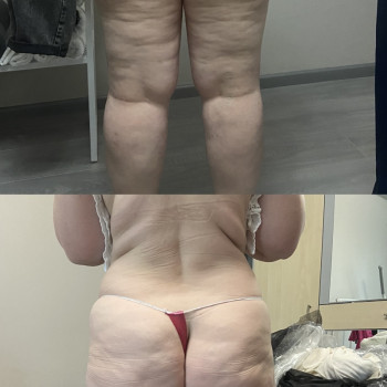 LPG массаж
                    Мануальный терапевт Виктория Киев