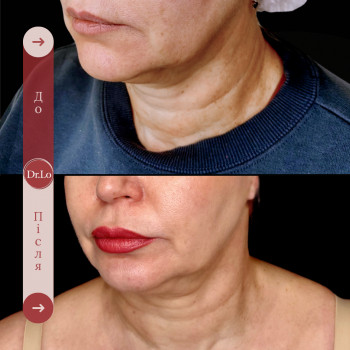 корекція зони брил