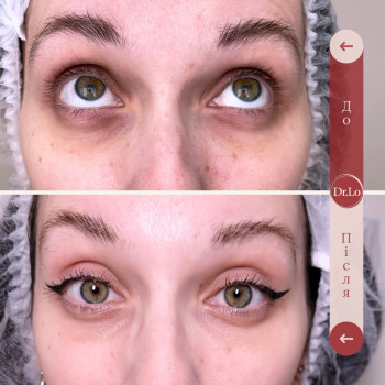 лікування темних кіл навколо очей