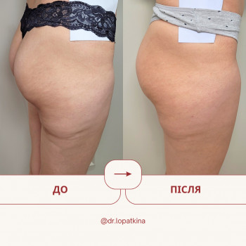 лікування стрий і розтяжок