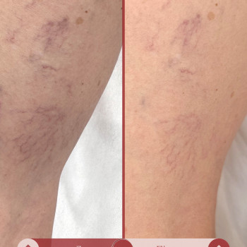 Видалення судин на ногах та обличчі