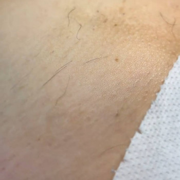 Електроепіляція бікіні, майже фініш