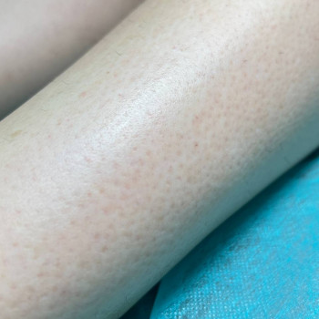 Електроепіляція ніг після 3-х процедур