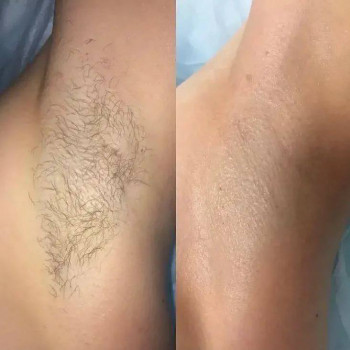 Воскова депіляція пахв