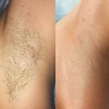 Воскова депіляція пахв