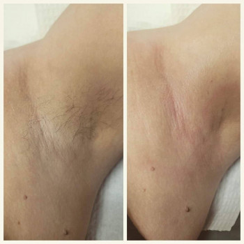 Воскова депіляція пахв