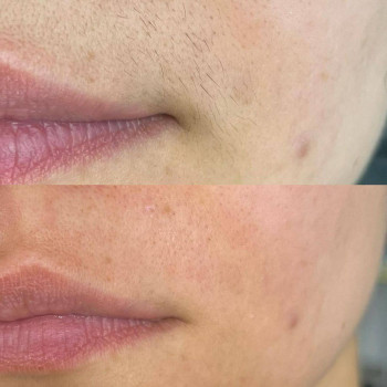 Воскова депіляція вусиків