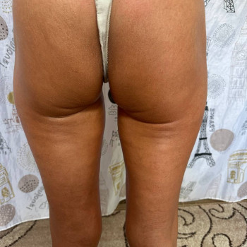 Масаж антицелюлітний
                    Реабілітолог Юлия Київ