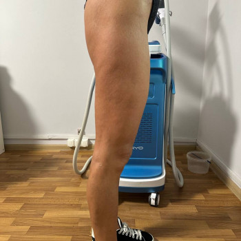 Масаж антицелюлітний
                    Реабілітолог Юлия Київ