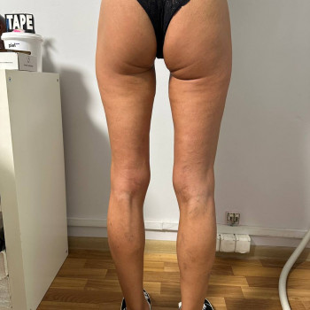 Масаж антицелюлітний
                    Реабілітолог Юлия Київ