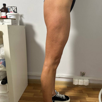 Масаж антицелюлітний
                    Реабілітолог Юлия Київ