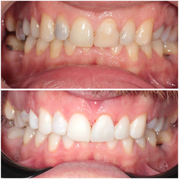 Відбілювання зубів Beyond у Хмельницькому. Білосніжна посмішка за 1 сеанс. Сучасна технологія, безпе...