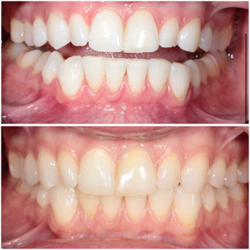 Білосніжна усмішка завдяки відбілюванню Beyond. Ефективна й безпечна процедура у стоматології Хмельн...