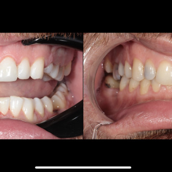 Професійне відбілювання Beyond – швидкий результат, довготривалий ефект та здорові зуби.