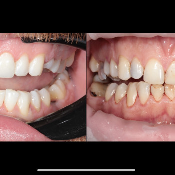 Фото до і після відбілювання зубів Beyond.