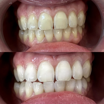 Результат за одну процедуру