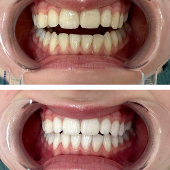 Результат 14 тонів без болю та чутливості