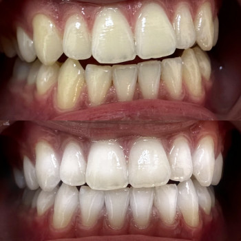 Процедура безболісна, не викликає чутливості, довготривалий ефект