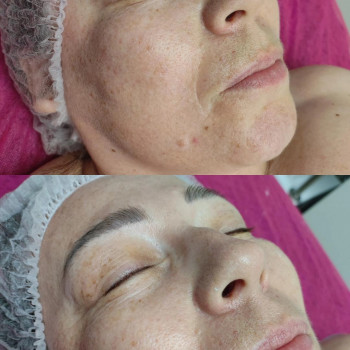 Спа для обличчя. 
1- очищення 
2- глибоке очищення 
3- масаж 
4- альгінантна маска 
5- сировотк...