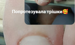 Протезирование ногтей Подолог Алена Горішні Плавні