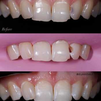 Лікування карієсу та художня реставрація ріжучих країв