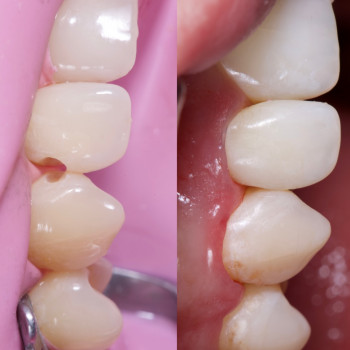 лікування карієсу