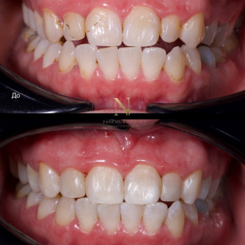 Професійна гігієна + Лікування карієсу 10 зубів