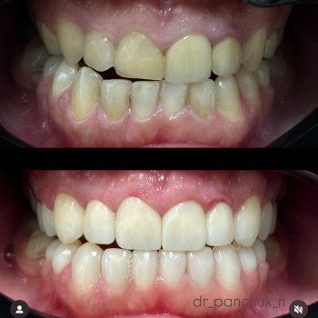 Комбінована робота: Верх - циркон 10 коронок, Низ - художня реставрація