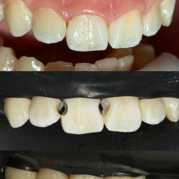 Лікування карієсу