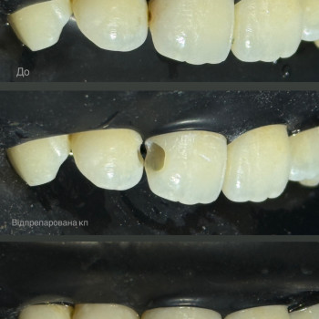 Лікування карієсу