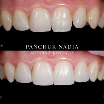 Художня реставрація 4 зубів