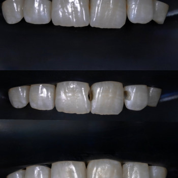 Лікування карієсу + реставрація ріжучих країв