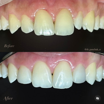 Художня реставрація 2 зубів (12,22)