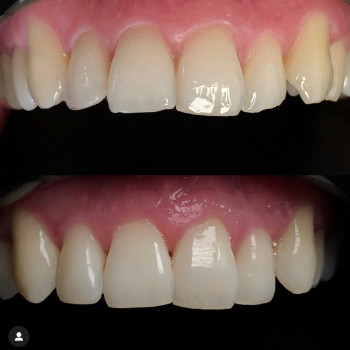 Художня реставрація 6 зубів