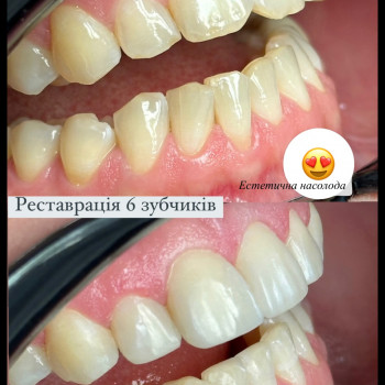 Художня реставрація 4 зубів