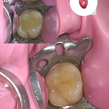 Лікування карієсу