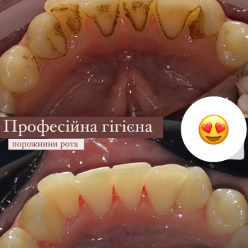 Професійна гігієна
                    Стоматолог Надія Київ