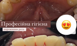 Професійна гігієна Стоматолог Надія Киев