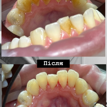 Професійна гігієна
                    Стоматолог Надія Київ