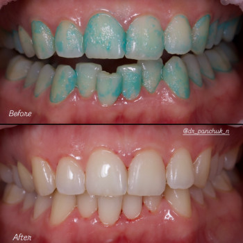 Професійна гігієна з індикатором нальоту