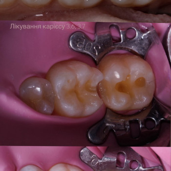 Лікування карієсу
                    Стоматолог Надія Киев