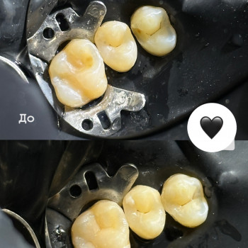Лікування карієсу
                    Стоматолог Надія Киев
