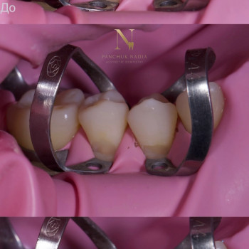 Лікування карієсу
                    Стоматолог Надія Киев