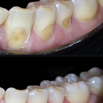 Лікування карієсу
                    Стоматолог Надія Киев