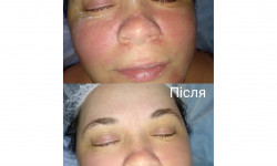 Чистка лица Косметолог Мар'яна Трускавец