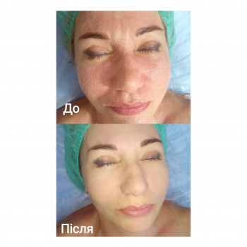 Чистка до/після, без почервонінь.