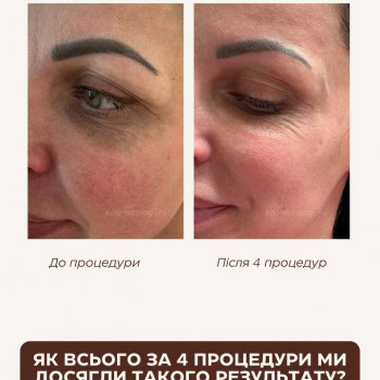 Результат після курсу мікроголкового рф ліфтингу