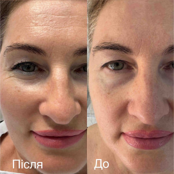 Результат після курсу мікроголкового рф ліфтингу