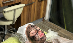 Лазерный карбоновый пилинг Лешмейкер Світлана Київ